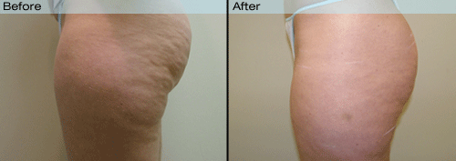 Velashape before and after pictures