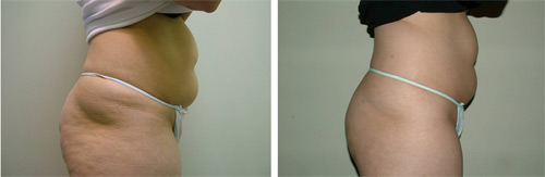 Velashape before and after pictures