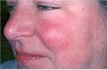 Rosacea before and after pictures