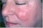 Rosacea before and after pictures